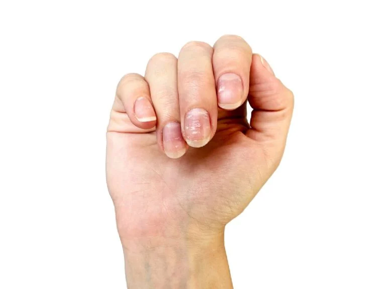 Por qué salen manchas blancas en las uñas