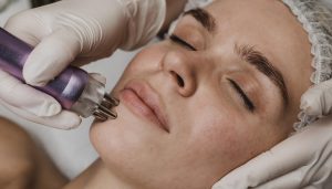 beneficios microdermoabrasion en la cara