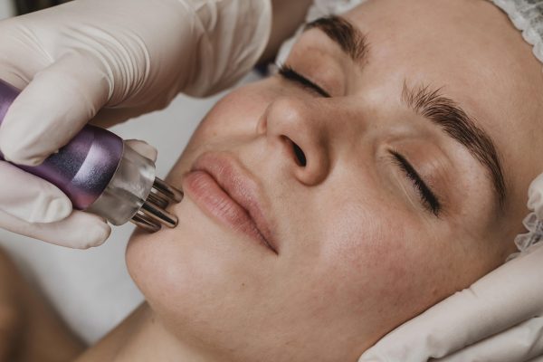 beneficios microdermoabrasion en la cara